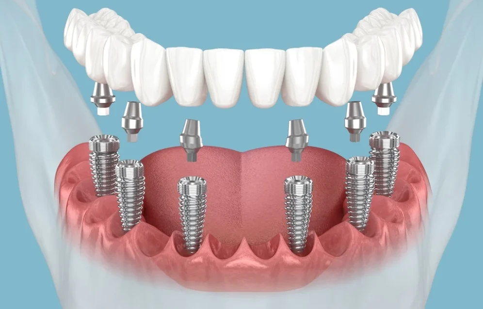 All-on-6 Dental Implants Cost All-on-6 Dental Implants Cost