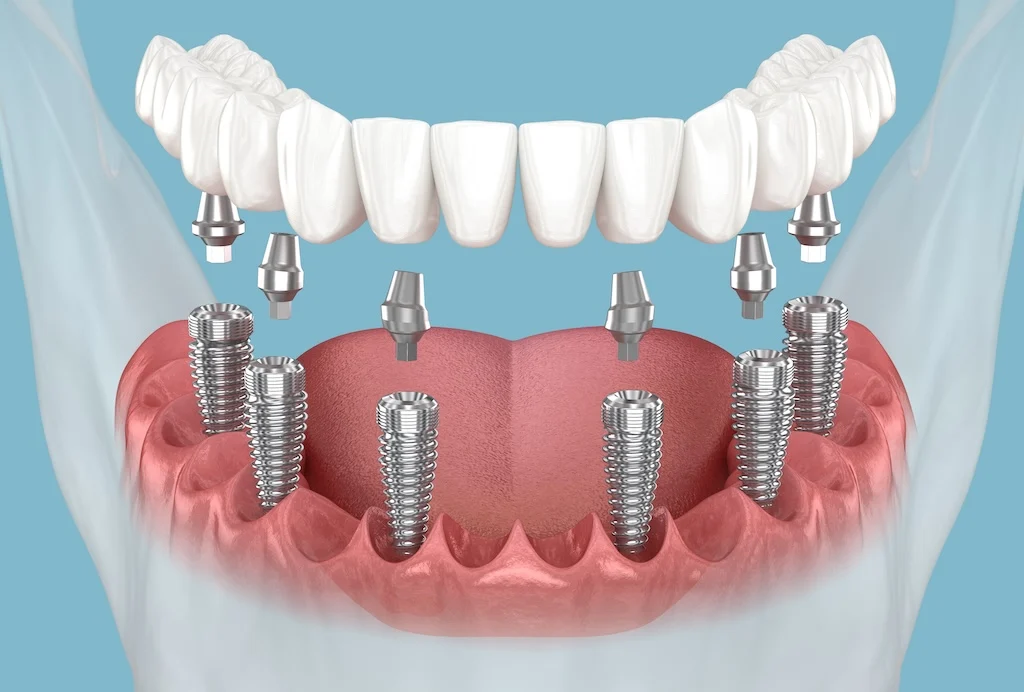 All-on-6 Dental Implants Cost
