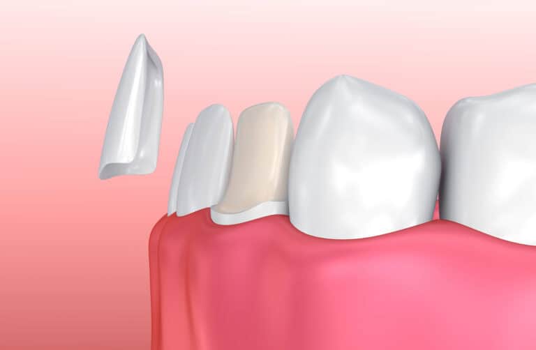 Porcelain veneers can fix chipped, stained, gapped, slightly crooked, or unusually shaped teeth all at once.