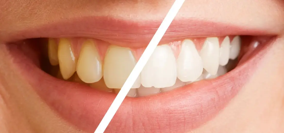 teeth-whitening-difference teeth-whitening-difference