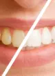 teeth-whitening-difference