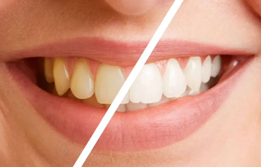 teeth-whitening-difference teeth-whitening-difference